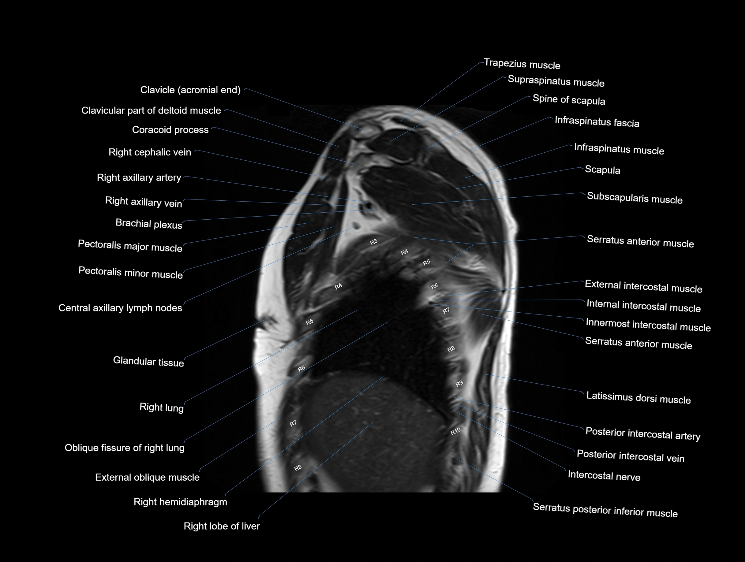 MRI chest (thorax) coronal  cross sectional anatomy 3T radiology  image-img-00001-00006.webp
